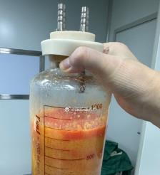 冷水江水动力吸脂手术要做多久？